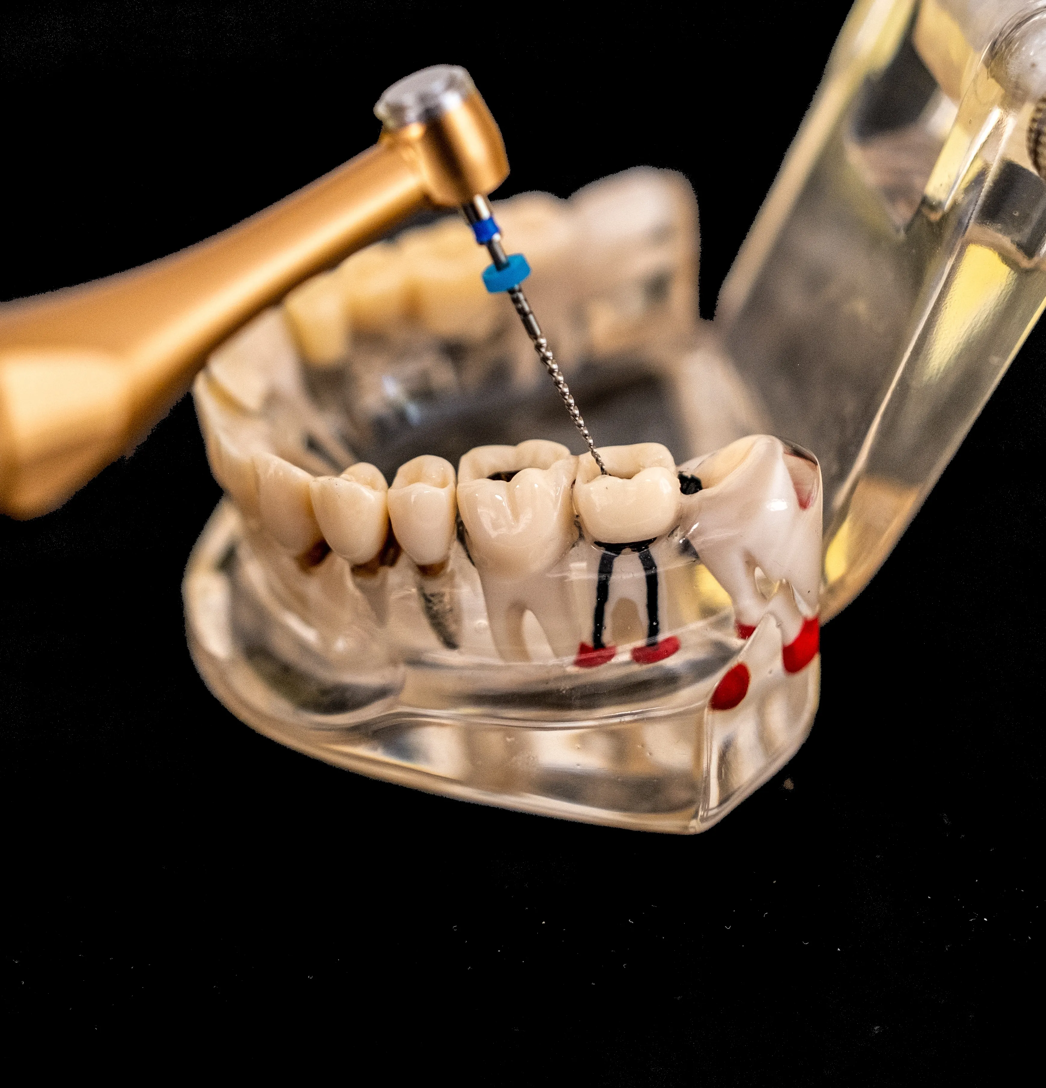 Root Canal Therapy in Lakewood, CO